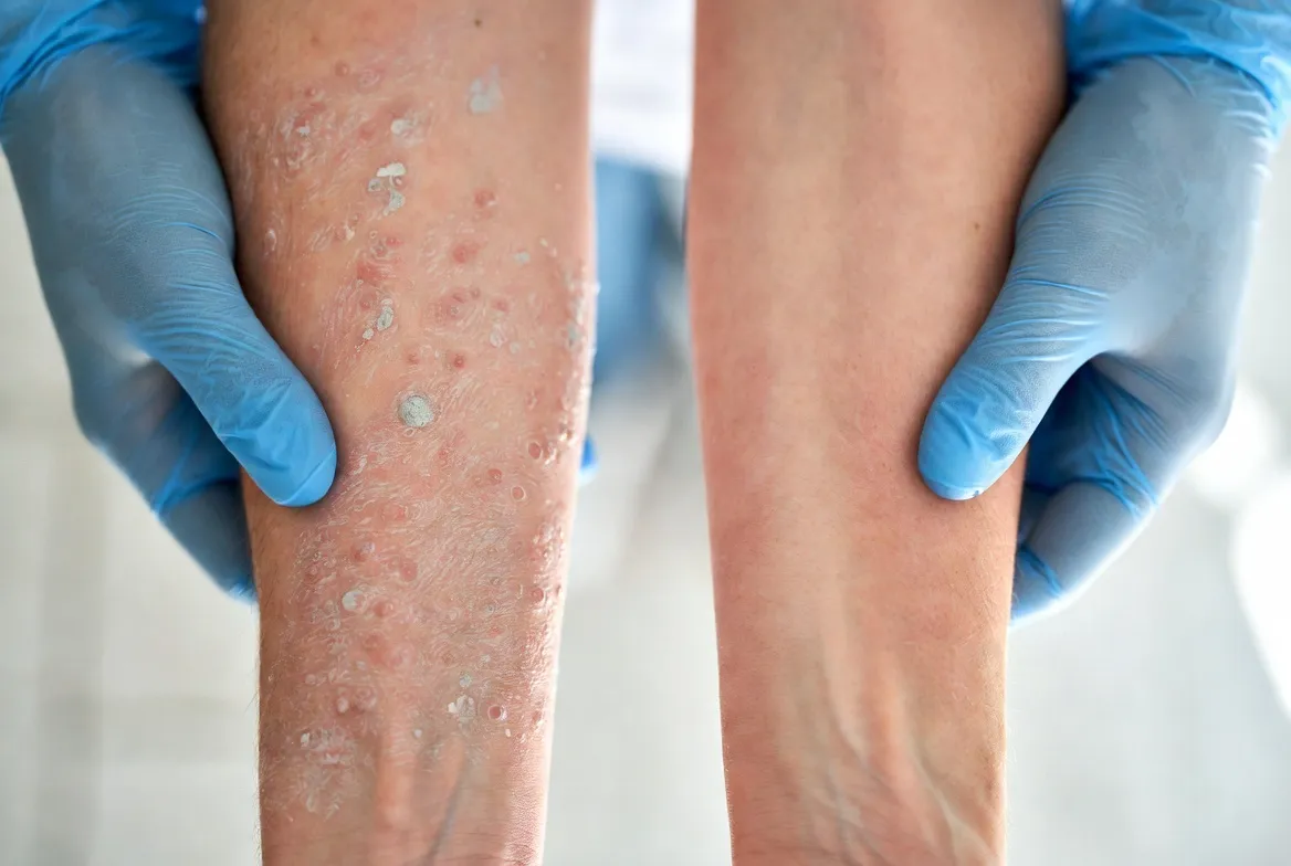 Psoriasis or Eczema